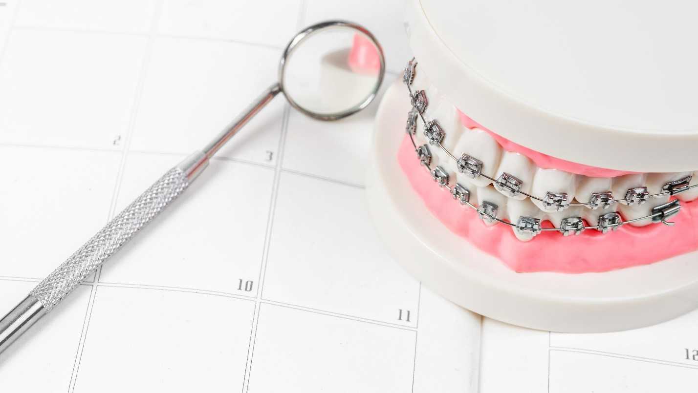 Calendar Showing Frequency Of Orthodontic Appointments Calendar Showing Frequency Of Orthodontic Appointments