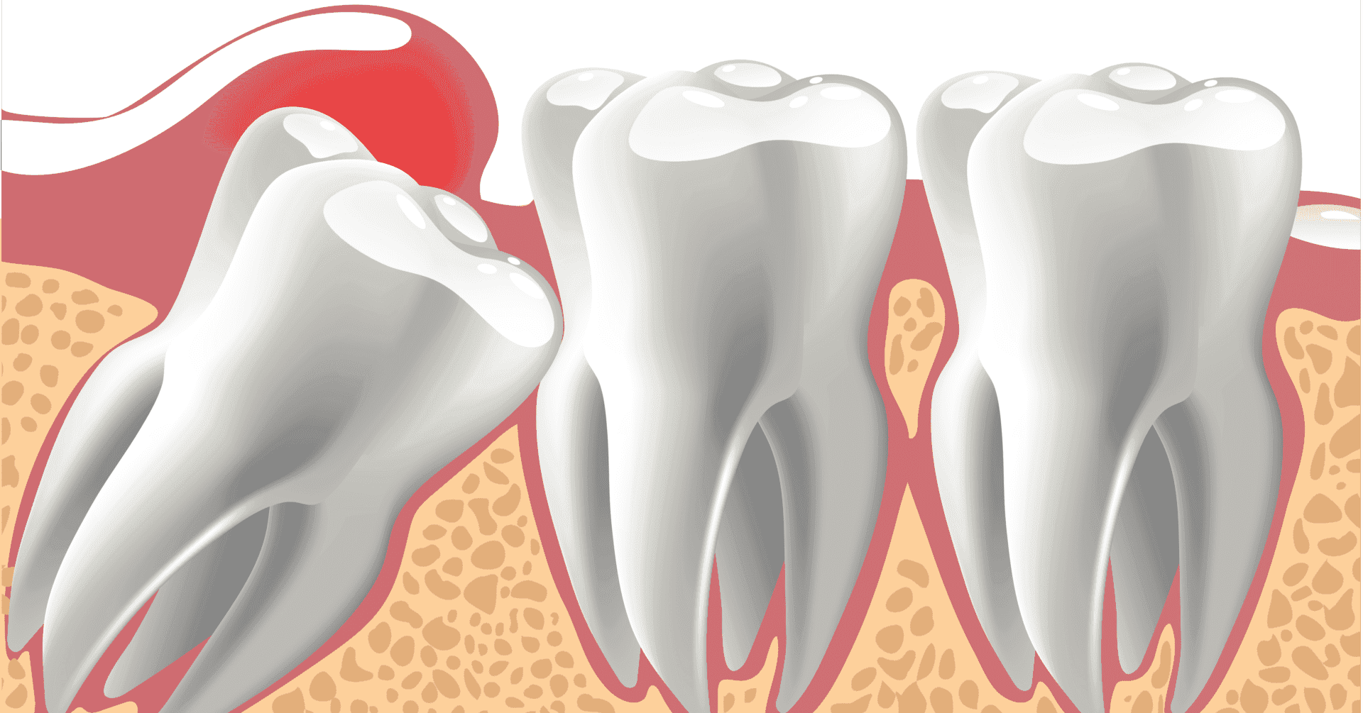 Impacted Tooth 01 Impacted Tooth 01