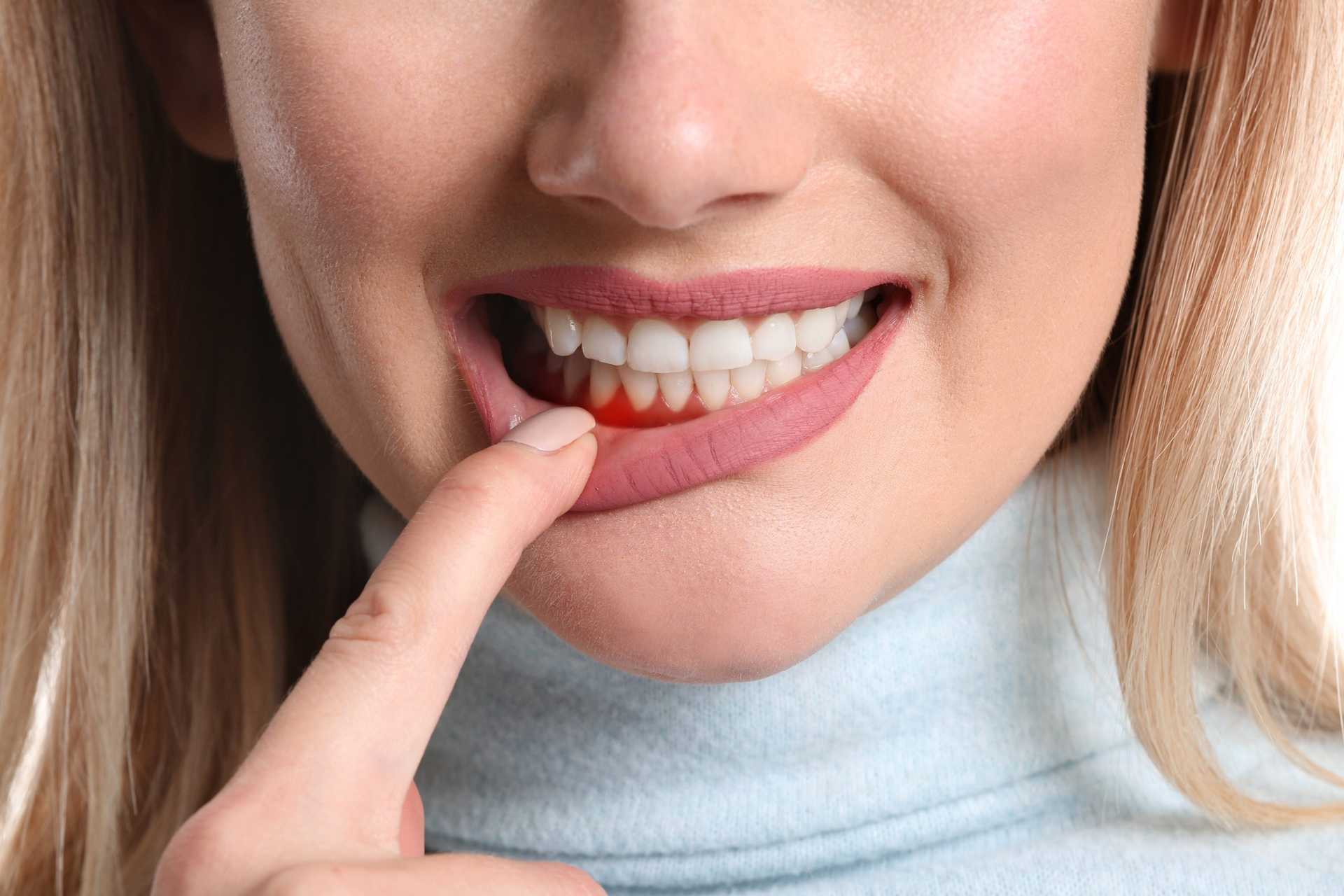 Woman,with,gum,inflammation,,closeup Picture of woman pulling on bottom lip to show red gums