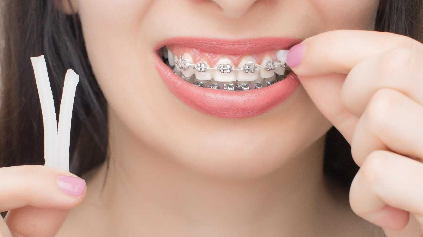 Can You Eat With Orthodontic Wax Girl applies orthodontic wax and wonders, “can you eat with orthodontic wax?”